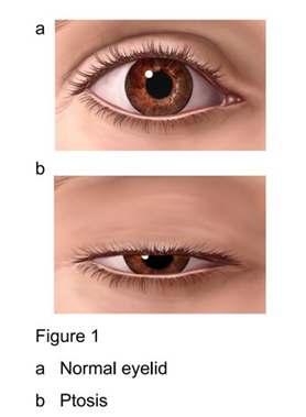 ptosis surgery parkside hospital ptosis surgery parkside hospital